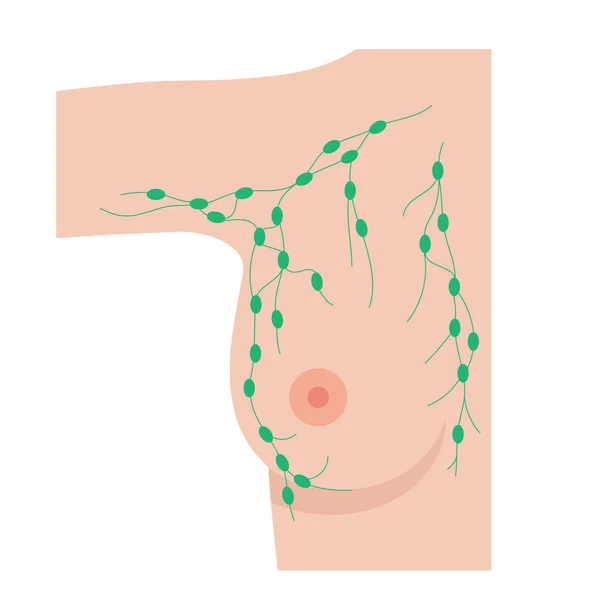 Concepto de enfermedad mamaria — Archivo Imágenes Vectoriales