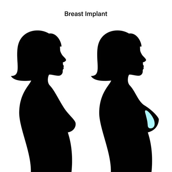 Concept d'implant mammaire — Image vectorielle