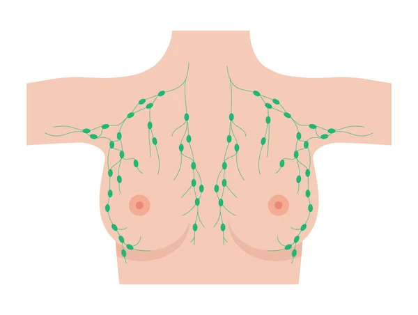 Concepto de enfermedad mamaria — Archivo Imágenes Vectoriales