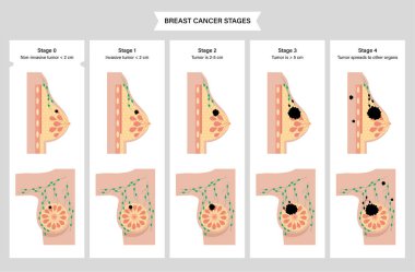 Breast disease concept clipart