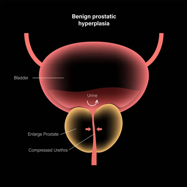 BPH info concept — Image vectorielle