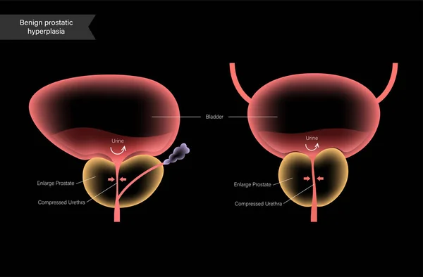 BPH info concept — Image vectorielle