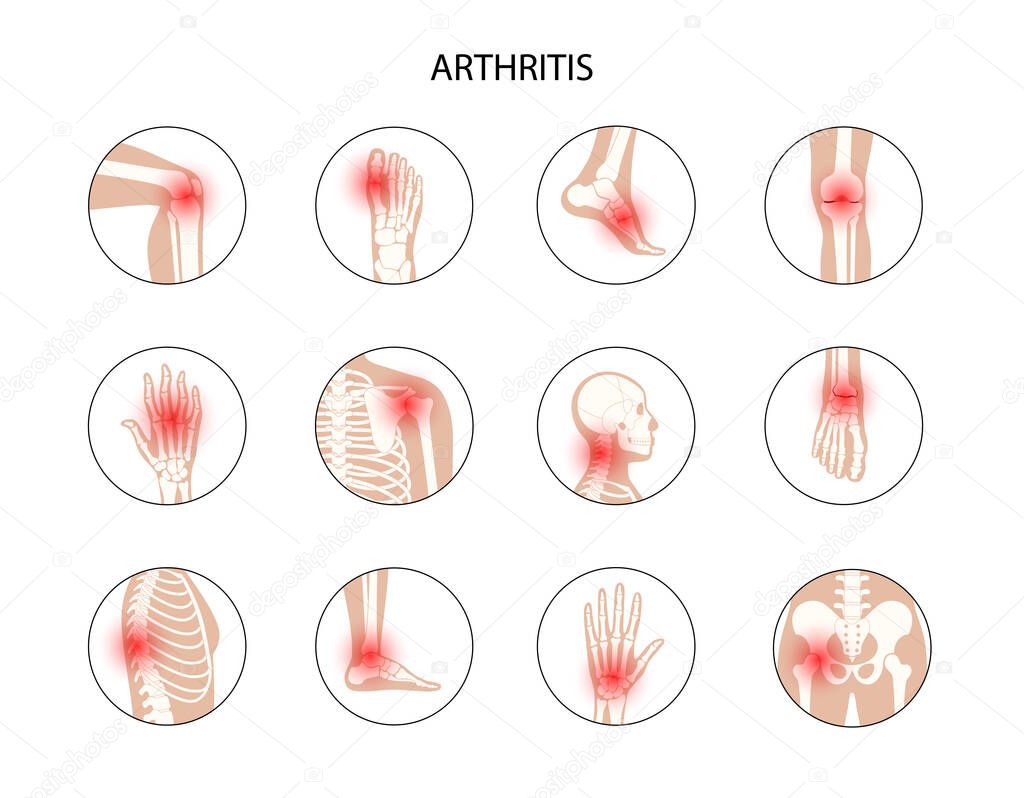 Set with spine, knee, wrist and other joint icons for clinic. Pain in the human body, anatomical logo concept. Arthritis, inflammation, bone fracture medical poster or banner. Flat vector illustration