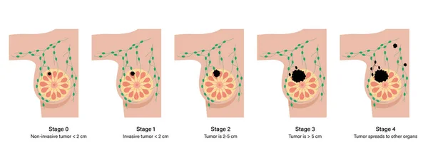 乳腺癌的概念 — 图库矢量图片