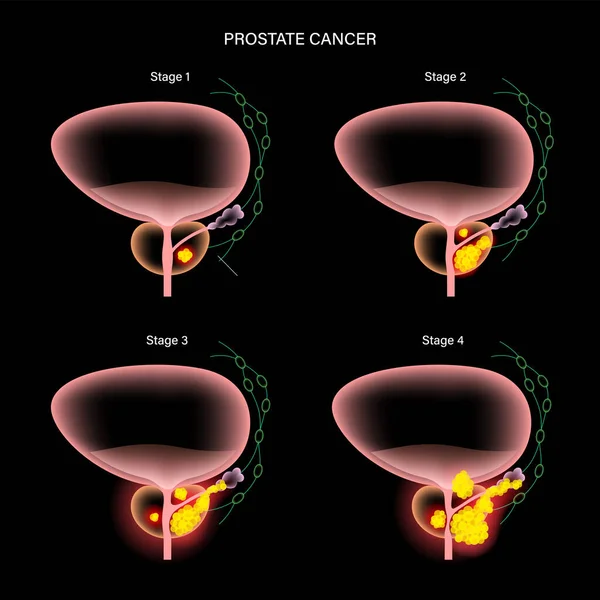 Prostatacancer koncept — Stock vektor