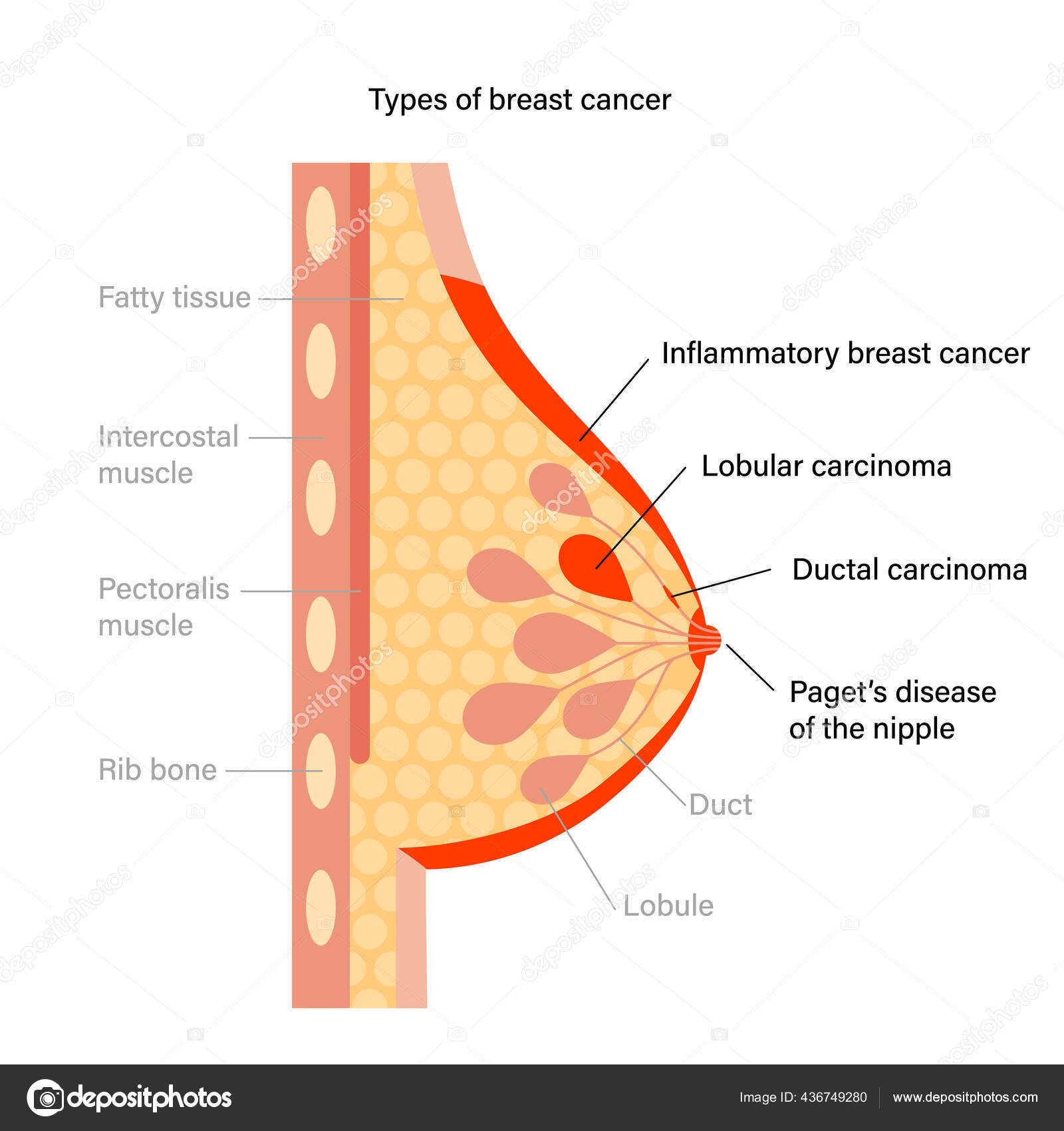 Begrepet brystsykdom stockvektor © Pikovit #436749280, image size:1600x1700