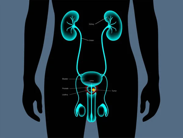 Concepto de cáncer de próstata — Archivo Imágenes Vectoriales