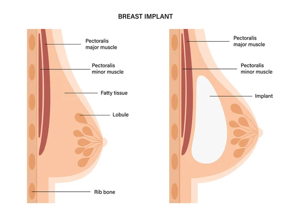 Concepto de implante mamario — Vector de stock