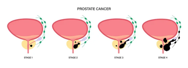 Concepto de cáncer de próstata — Vector de stock