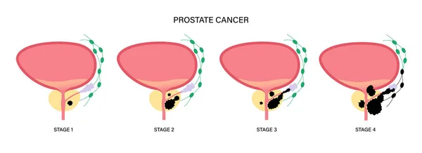 Concepto de cáncer de próstata — Archivo Imágenes Vectoriales