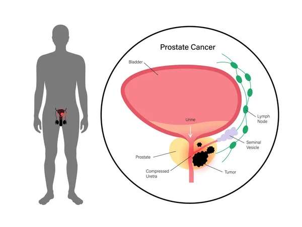 Concepto de cáncer de próstata — Vector de stock