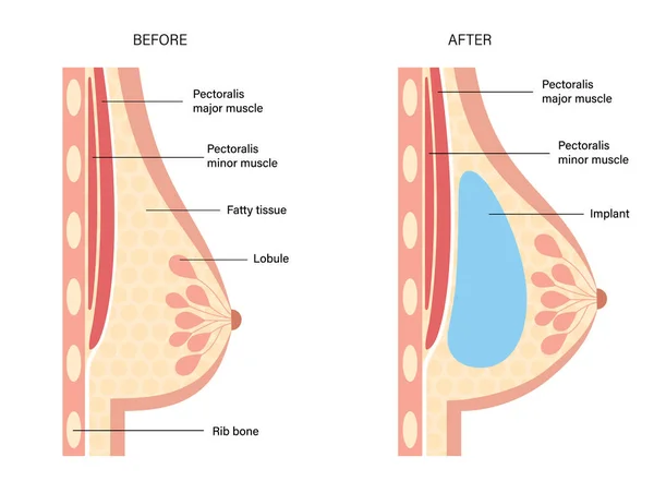 Concepto de implante mamario — Archivo Imágenes Vectoriales