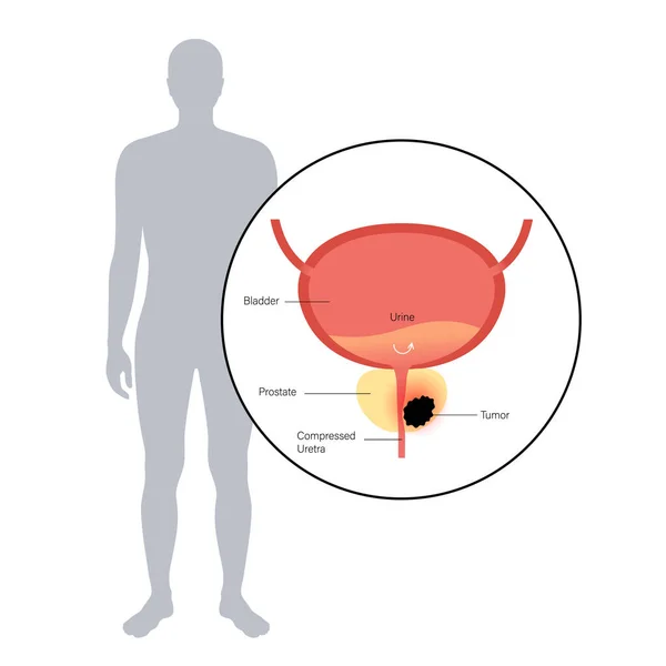 Koncept karcinomu prostaty — Stockový vektor