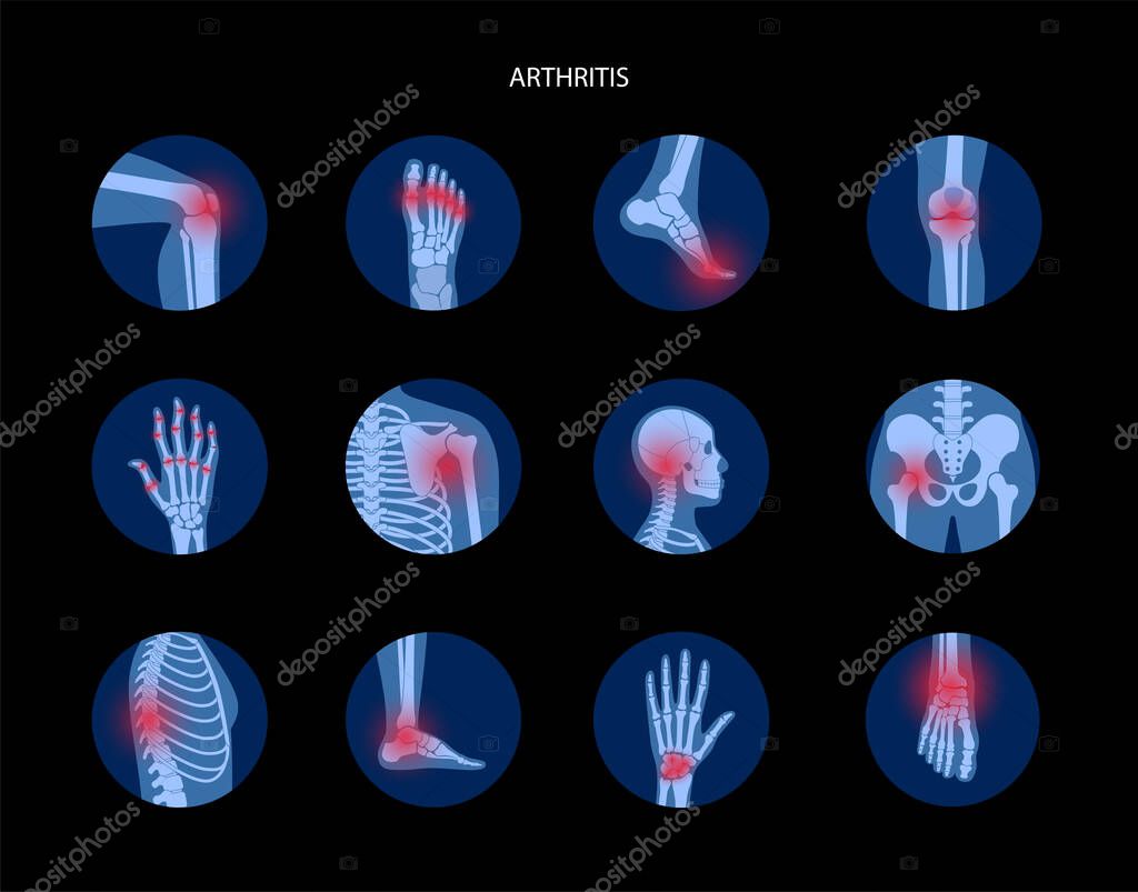 Set with spine, knee, wrist and other joint icons for clinic. Pain in the human body, anatomical logo concept. Arthritis, inflammation, bone disease medical poster or banner. Flat vector illustration.