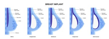 Göğüs implantı kavramı