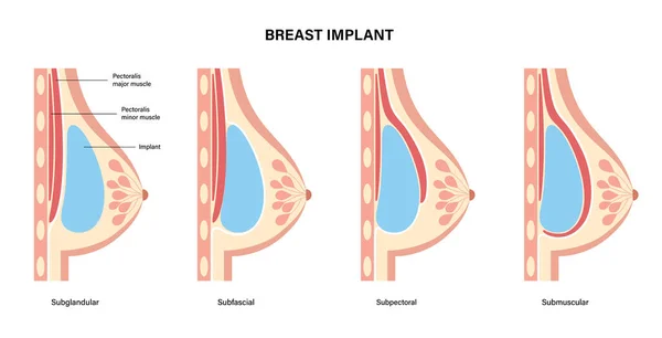 Conceito de implante mamário — Vetor de Stock