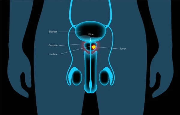 Concepto de cáncer de próstata — Archivo Imágenes Vectoriales