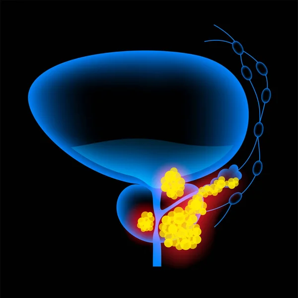 Концепция рака предстательной железы — стоковый вектор