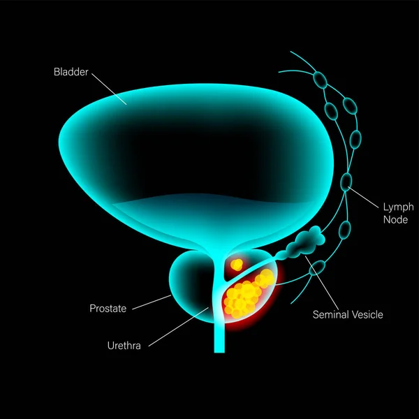 Concetto di cancro alla prostata — Vettoriale Stock