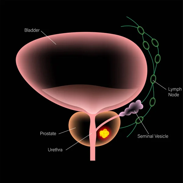 Concepto de cáncer de próstata — Archivo Imágenes Vectoriales