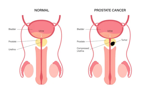 Concetto di cancro alla prostata — Vettoriale Stock