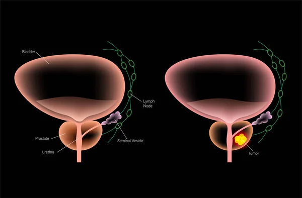 Concepto de cáncer de próstata — Archivo Imágenes Vectoriales