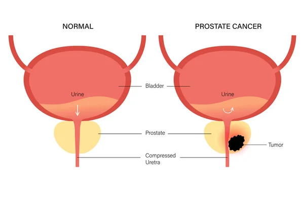 Koncept karcinomu prostaty — Stockový vektor