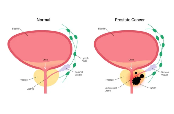 Prostaatkankerconcept — Stockvector