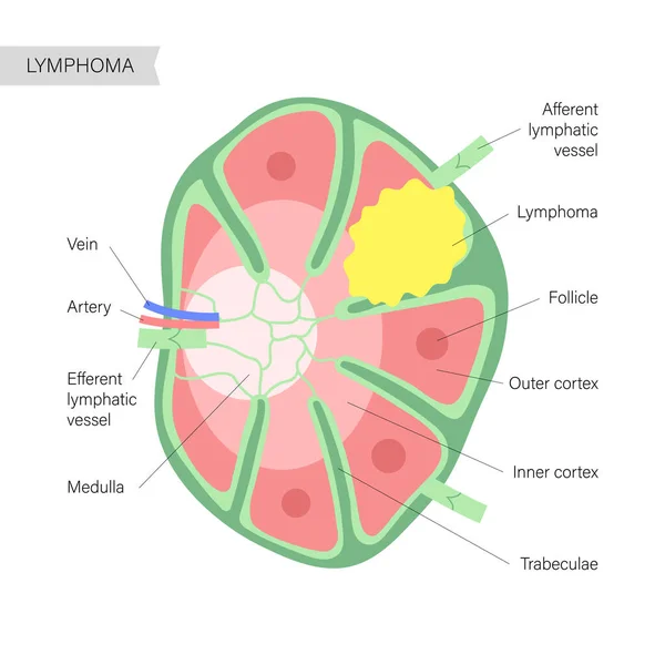 Concepto de cáncer de linfoma — Vector de stock