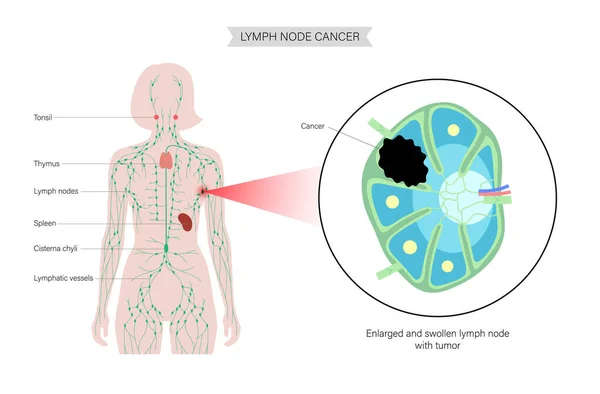 Lymphom-Krebs-Konzept — Stockvektor