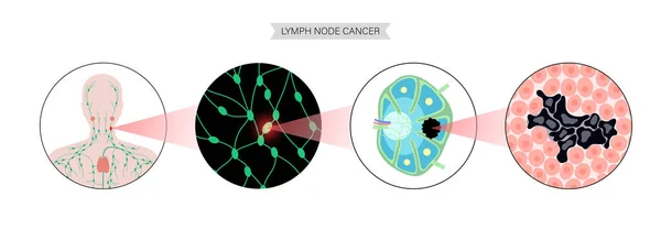 Koncept rakoviny lymfomu — Stockový vektor