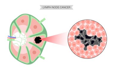 Lenfoma kanseri kavramı