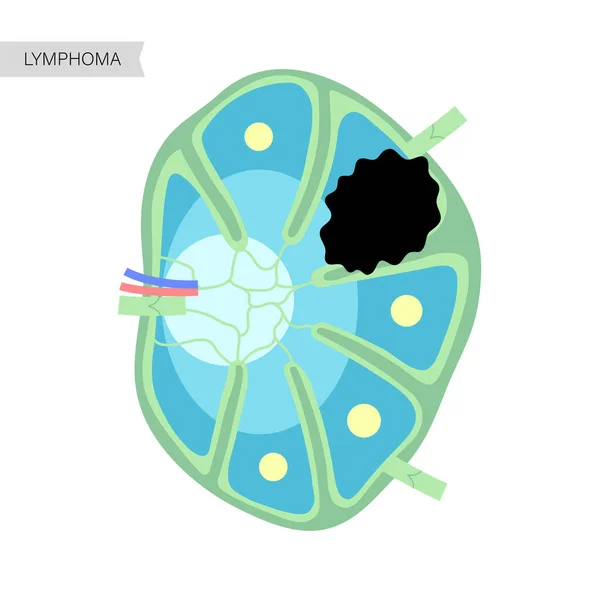 Concepto de cáncer de linfoma — Vector de stock