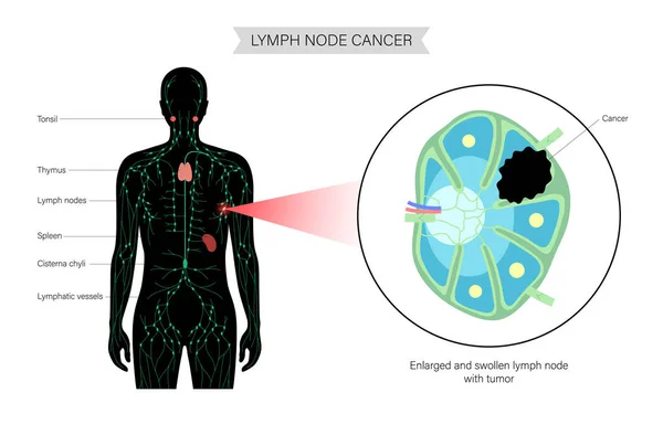 Concepto de cáncer de linfoma — Vector de stock