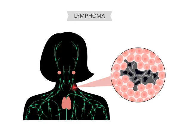 Concepto de cáncer de linfoma — Vector de stock