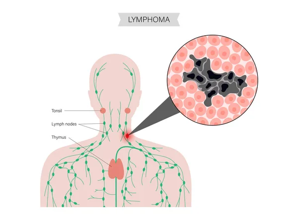 Concetto di cancro del linfoma — Vettoriale Stock