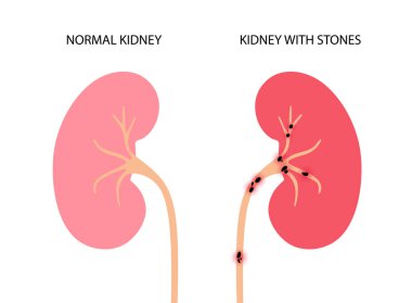 Böbrek hastalığı konsepti