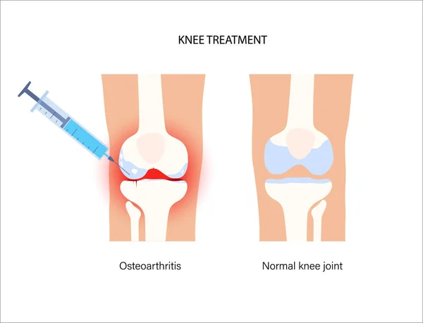 Knie Injectie concept — Stockvector