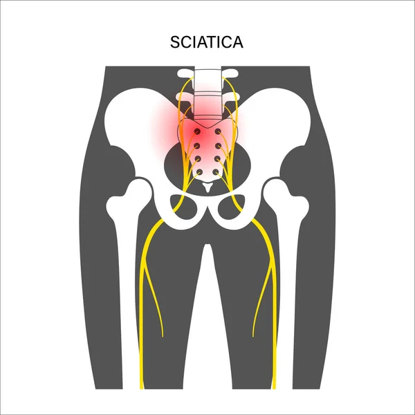 Muscular pelvis concept — Stock Vector