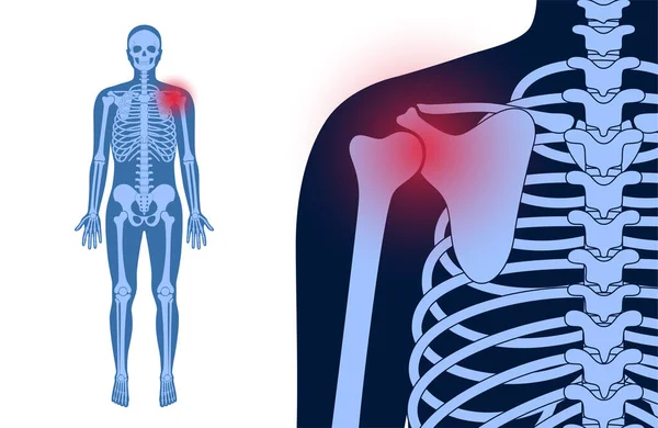 Концепция болей в плечах — стоковый вектор