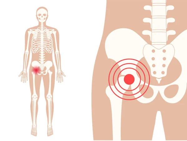 Douleur et maladie de la hanche — Image vectorielle