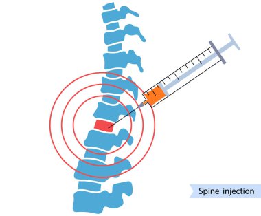 Spine joint injection  clipart