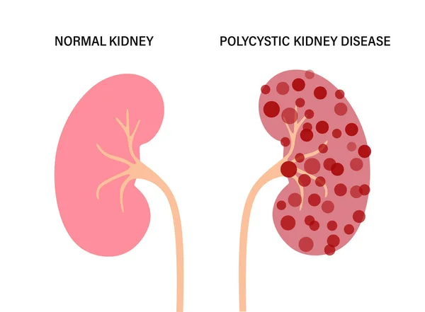 Concepto de enfermedad renal — Archivo Imágenes Vectoriales