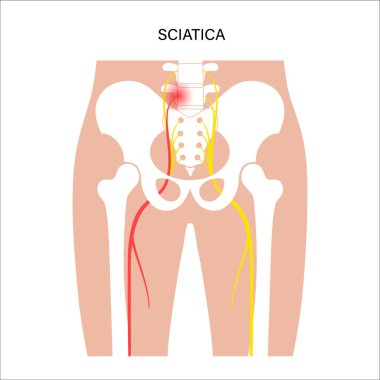 Muscular pelvis sciatica clipart