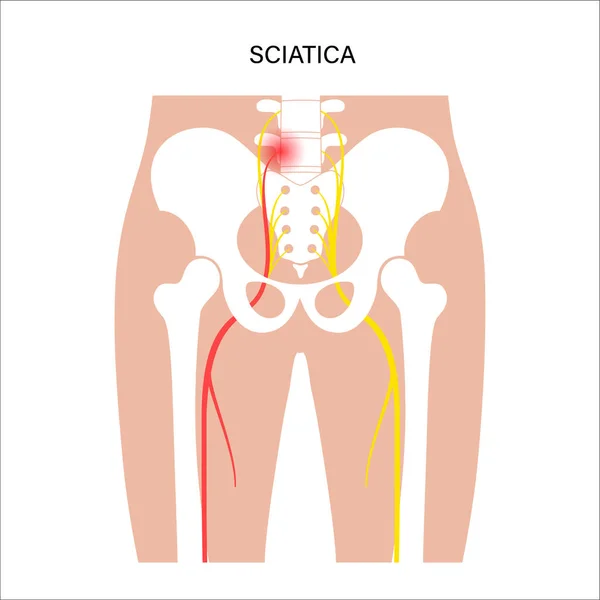 Sciatique du bassin musculaire — Image vectorielle