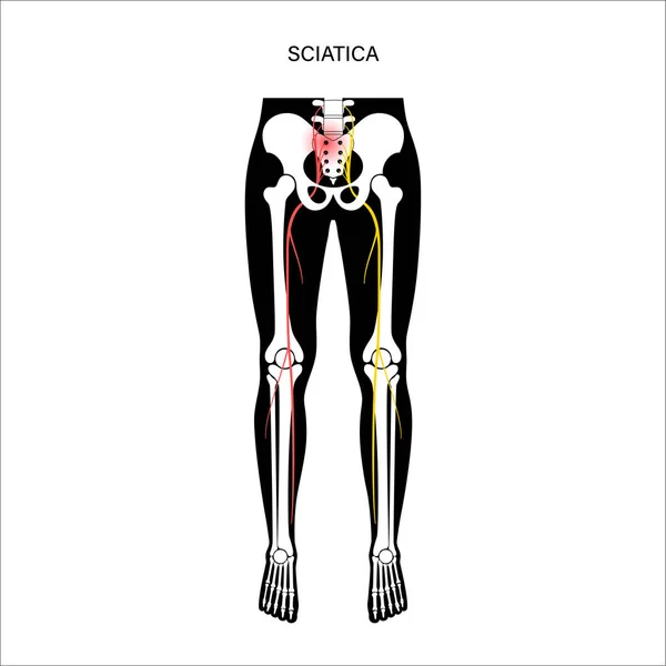 Pelvis muscular ciática — Archivo Imágenes Vectoriales