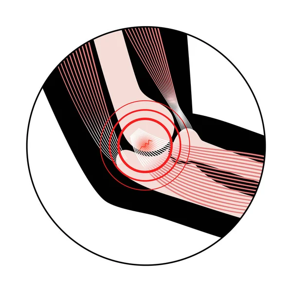 Eicondilitis medial codo de golfista — Archivo Imágenes Vectoriales