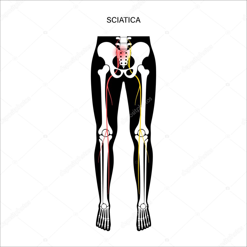 Muscular pelvis sciatica