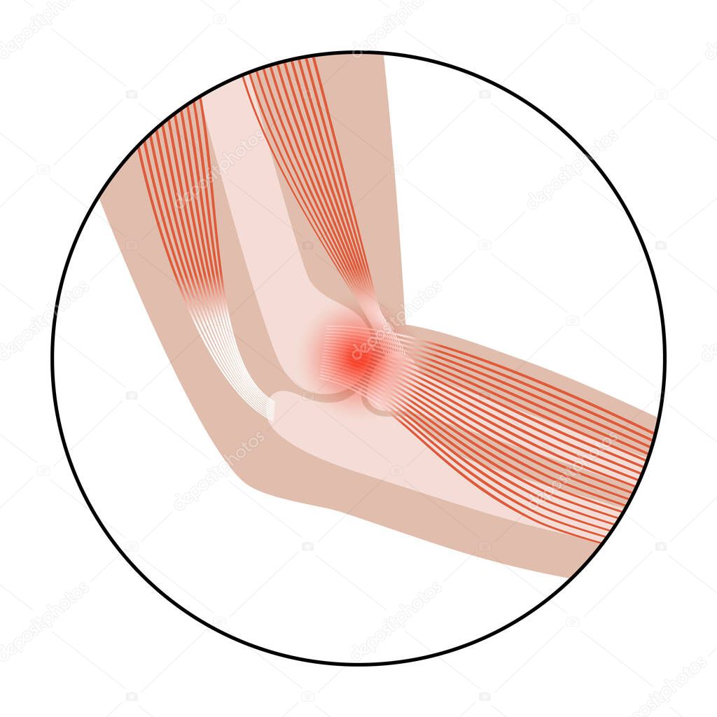 Pain in human arm. Lateral epicondylitis tennis elbow. Trauma or inflammation in hand. Muscular system and skeletal anatomical poster. Structure of muscle groups and bones isolated vector illustration