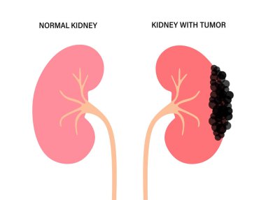 Böbrek hastalığı konsepti